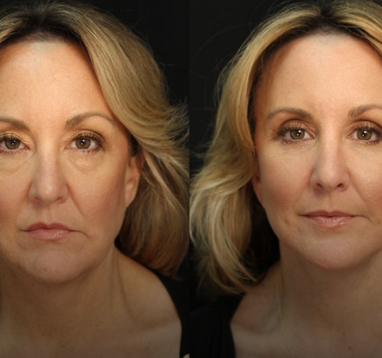 Are Facelifts Natural-Looking