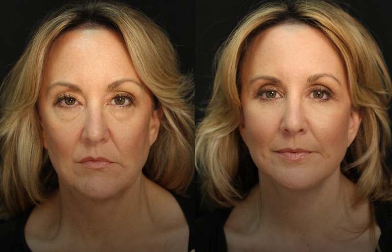 Are Facelifts Natural-Looking