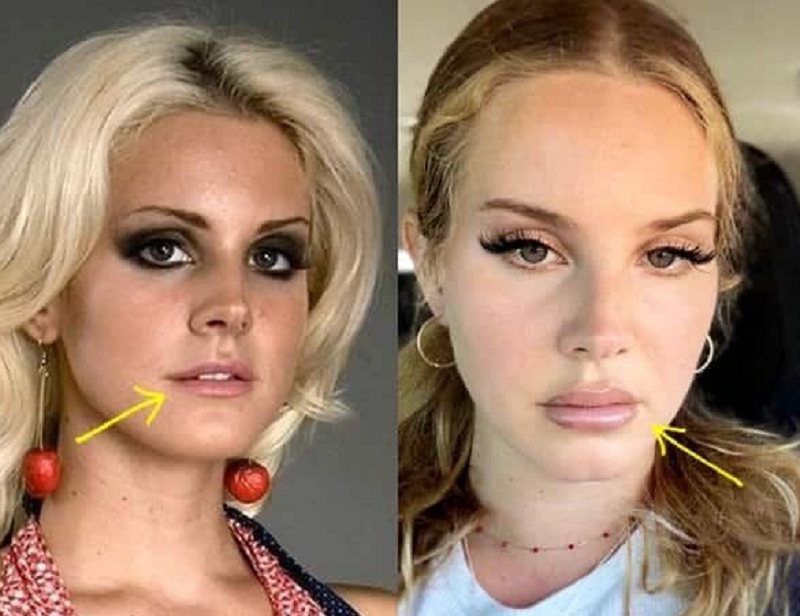 Did Lana Del Rey have Plastic Surgery